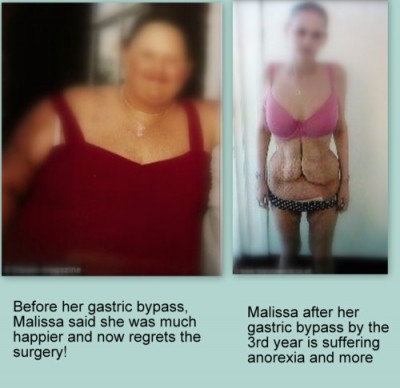 Gastric-Bypass