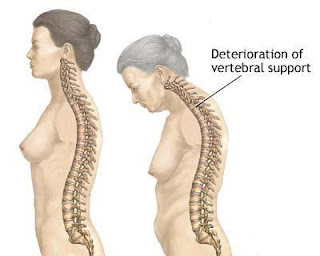 Kesan osteoporosis apabila meningkat usia.