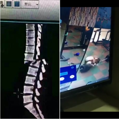 Video Patah Tulang Belakang